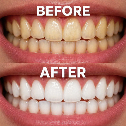 Teeth Whitening Strips